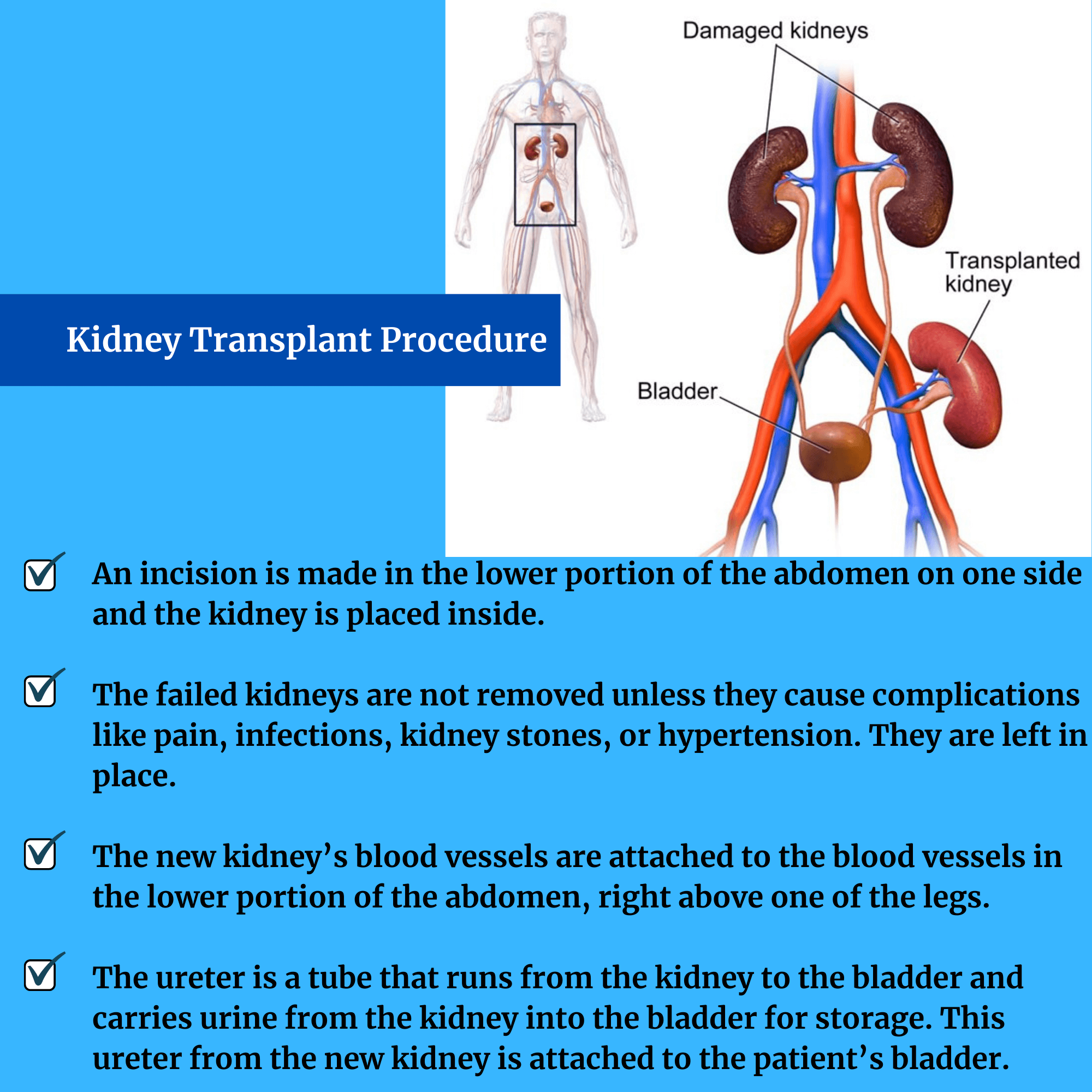 Kidney Transplant Specialist in India